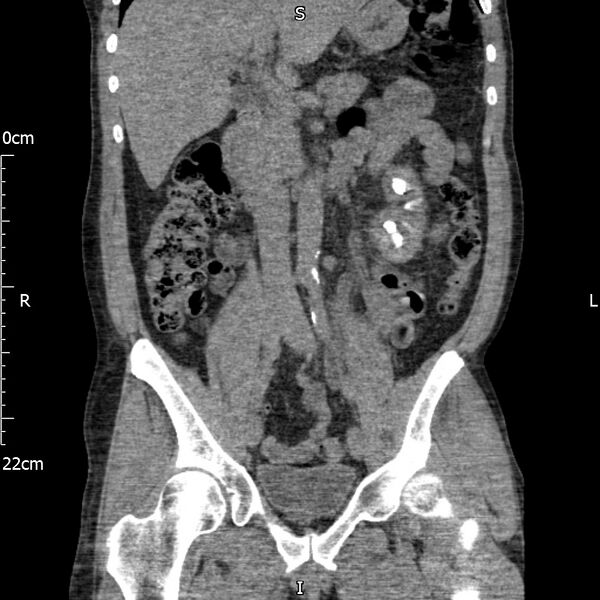 File:Bilateral medullary nephrocalcinosis with ureteric calculi (Radiopaedia 71269-81569 Coronal non-contrast 32).jpg