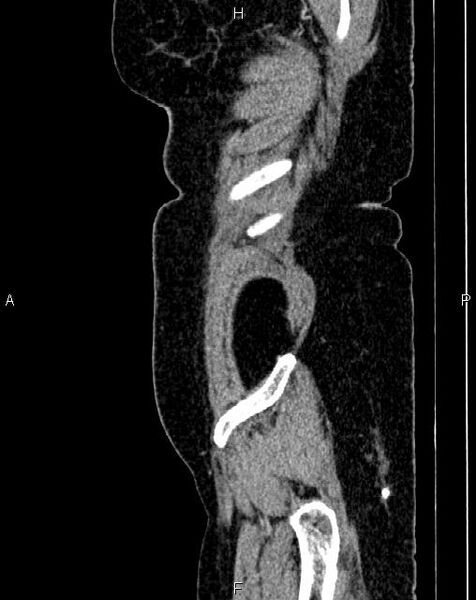 File:Bilateral ovarian serous cystadenocarcinoma (Radiopaedia 86062-101989 E 2).jpg