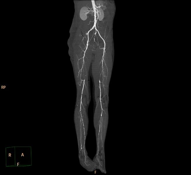 File:Bilateral superficial femoral arterial occlusion (Radiopaedia 25682-25857 3D MIP 3).jpg