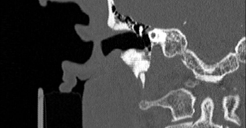 Bilateral temporal bone fractures (Radiopaedia 29482-29970 Coronal non-contrast 93).jpg