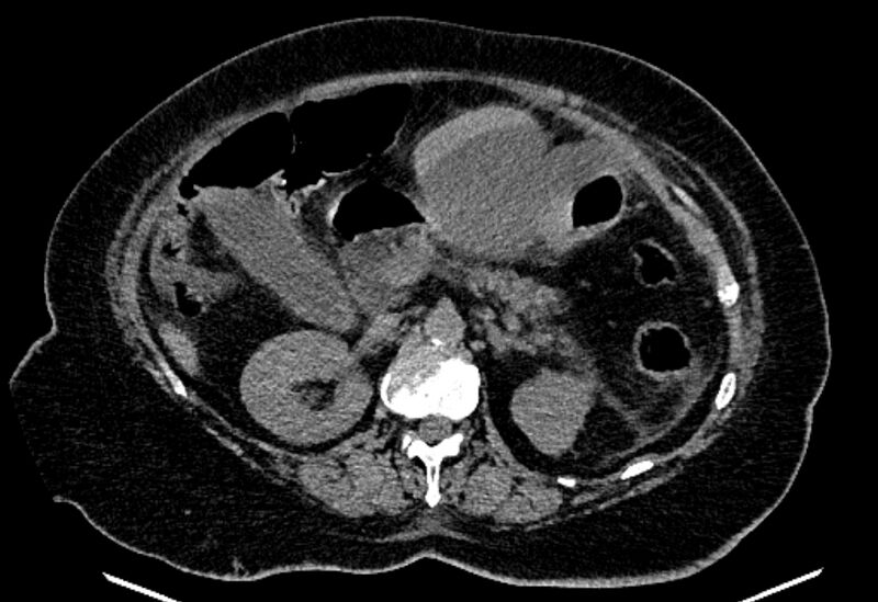 File:Biliary pancreatitis (Radiopaedia 72289-82823 Axial non-contrast 102).jpg