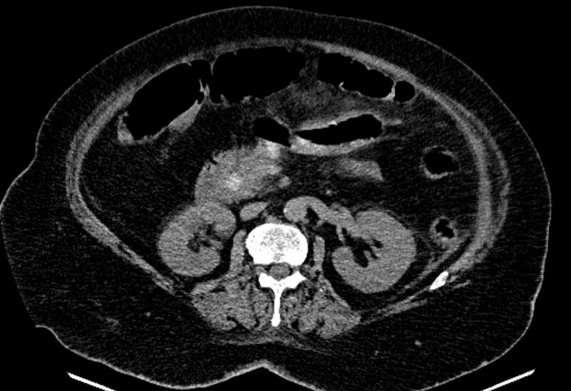 File:Biliary pancreatitis (Radiopaedia 72289-82823 Axial non-contrast 120).jpg