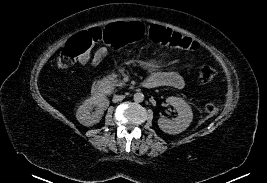 Biliary pancreatitis (Radiopaedia 72289-82823 Axial non-contrast 127).jpg