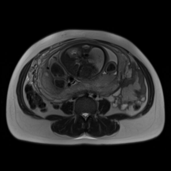 File:Bilobed placenta accreta (Radiopaedia 69648-79591 Axial T2 21).jpg