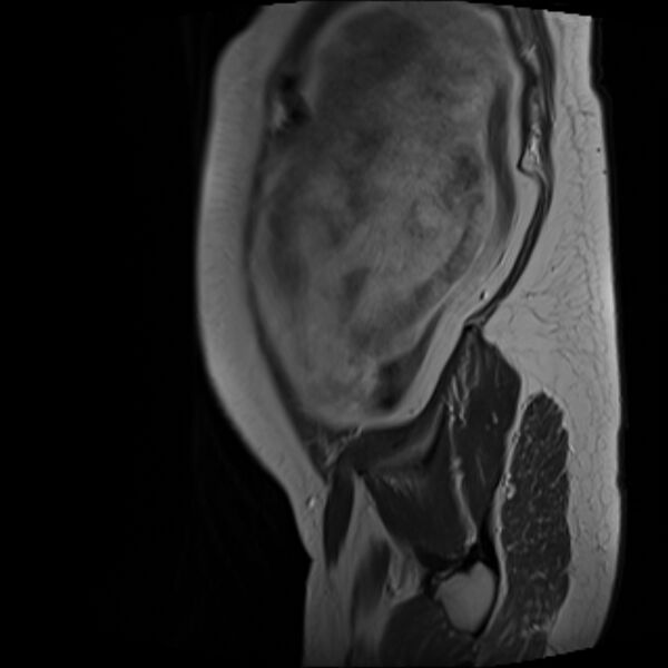 File:Bilobed placenta accreta (Radiopaedia 69648-79591 Sagittal T2 1).jpg