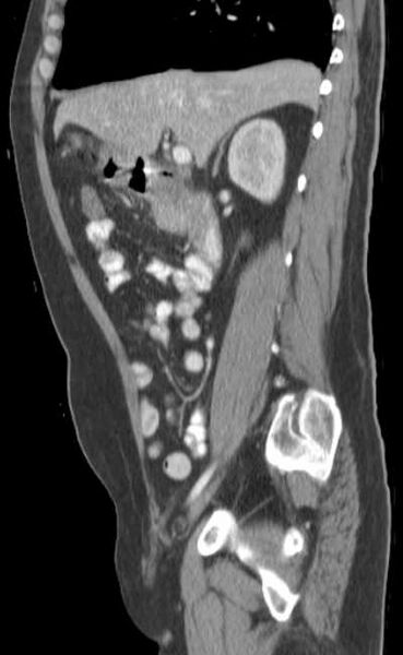 File:Bleeding duodenal ulcer and adenomyomatosis of gallbladder (Radiopaedia 61834-69861 C 37).jpg