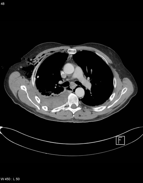 File:Boerhaave syndrome with tension pneumothorax (Radiopaedia 56794-63605 A 23).jpg