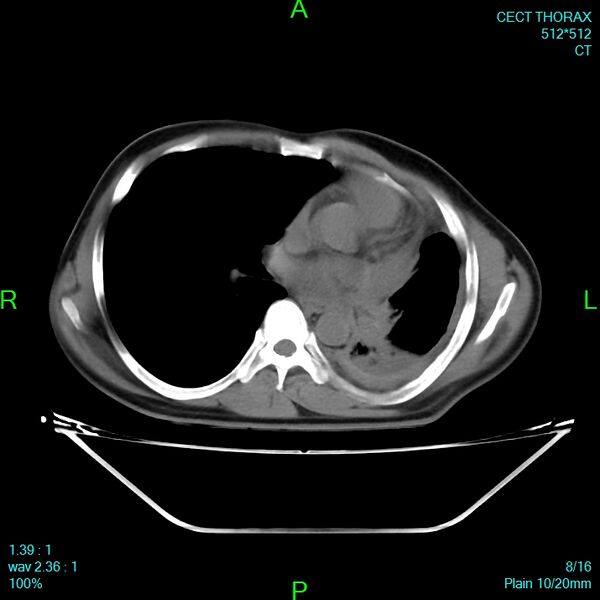 File:Bone metastases from lung carcinoma (Radiopaedia 54703-60937 Axial non-contrast 8).jpg