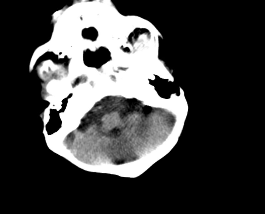 Brachycephaly (bi-coronal and bi-lambdoid synostosis) (Radiopaedia 55048-61413 Axial non-contrast 11).jpg