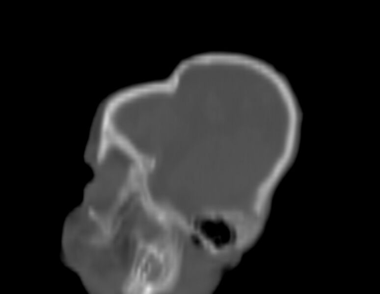 File:Brachycephaly (bi-coronal and bi-lambdoid synostosis) (Radiopaedia 55048-61413 Sagittal bone window 5).jpg