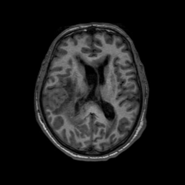 File:Brain abscess complicated by intraventricular rupture and ventriculitis (Radiopaedia 82434-96577 Axial T1 39).jpg