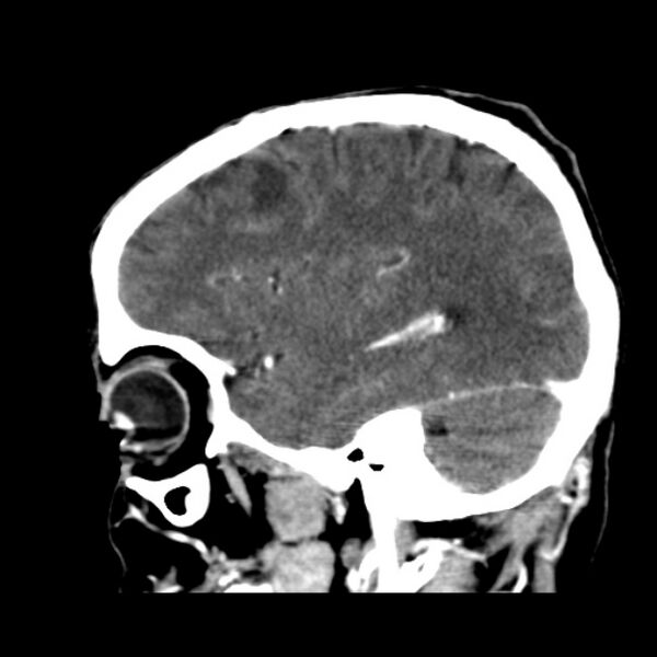 File:Brain metastases from lung cancer (Radiopaedia 24480-24781 C+ delayed 42).jpg