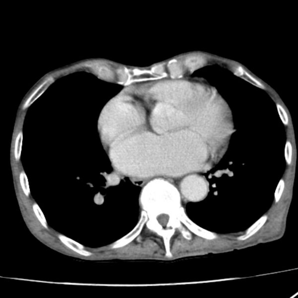 File:Brain metastases from lung cancer (Radiopaedia 27849-28093 D 41).jpg