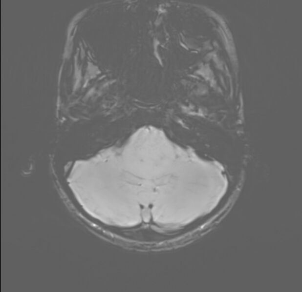 File:Brainstem glioma (Radiopaedia 70548-80674 Axial SWI 8).jpg