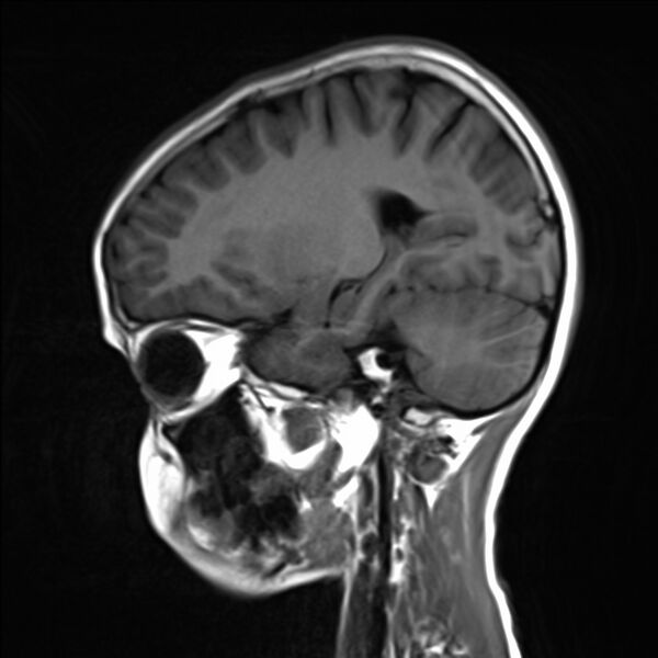 File:Brainstem glioma (Radiopaedia 70548-80674 Sagittal T1 17).jpg
