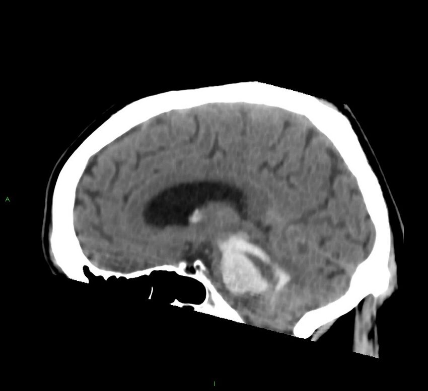 Brainstem hemorrhage (Radiopaedia 58794-66028 C 28).jpg