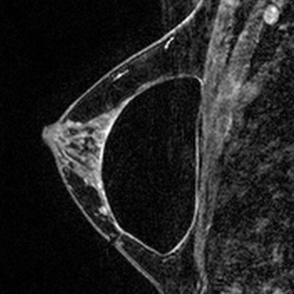 File:Breast implants - MRI (Radiopaedia 26864-27035 Sagittal T2 24).jpg