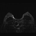 Breast implants - MRI (Radiopaedia 26864-27035 T2 SPAIR 35).jpg