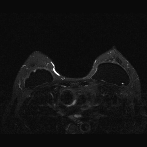 File:Breast implants - MRI (Radiopaedia 26864-27035 T2 SPAIR 35).jpg