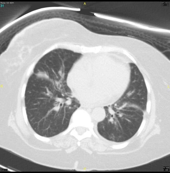 File:Breast primary with lung and bone metastases (Radiopaedia 40620-43228 Axial lung window 31).jpg