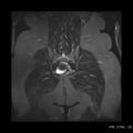 Broad ligament fibroid (Radiopaedia 49135-54241 Coronal STIR 23).jpg