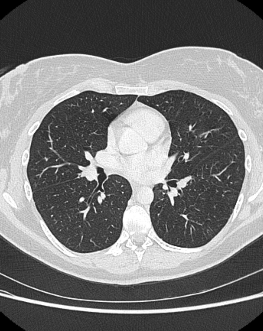 Bronchial atresia (Radiopaedia 50007-55297 Axial lung window 53).jpg