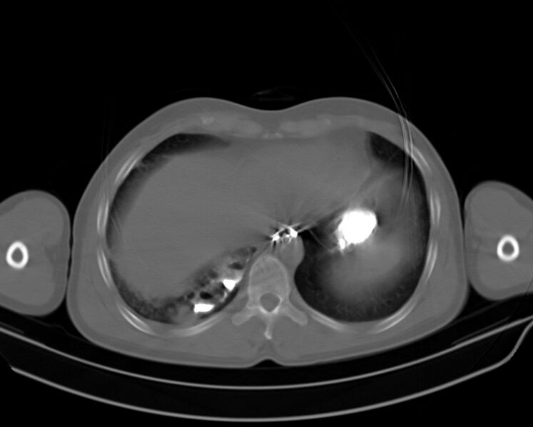 File:Broncho-esophageal fistula (Radiopaedia 29415-29889 Axial lung window 1).jpg