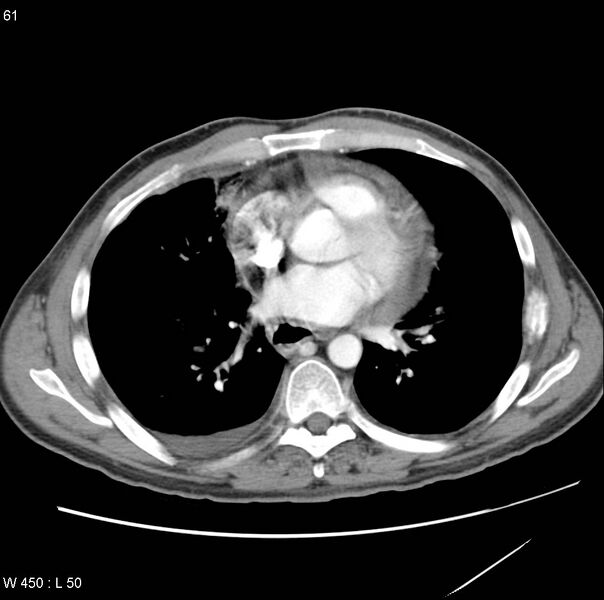File:Bronchogenic carcinoma (Radiopaedia 8857-9645 A 11).jpg