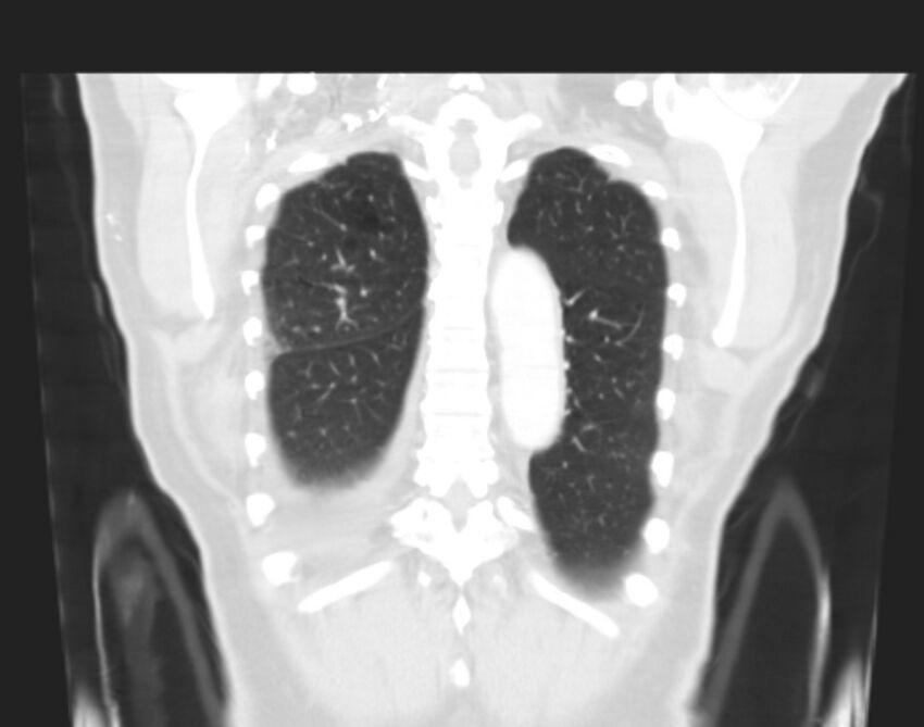 Bronchogenic carcinoma with lymphangitic spread (Radiopaedia 29002-29357 Coronal lung window 60).jpg