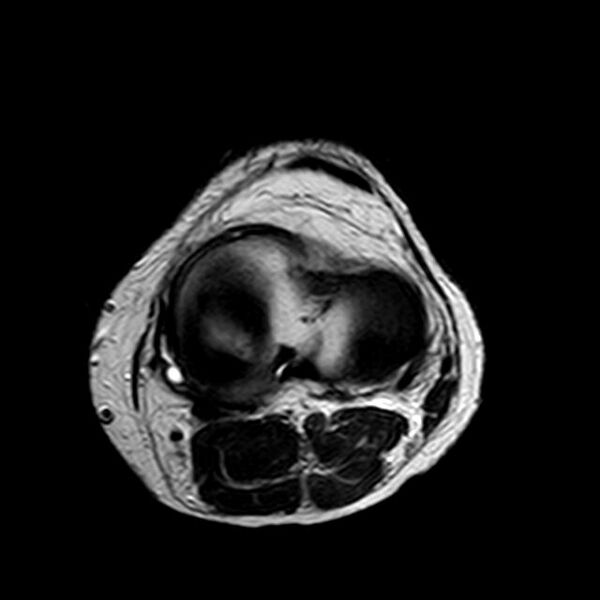 File:Bucket handle tear - medial meniscus (Radiopaedia 29250-29664 Axial T2 6).jpg