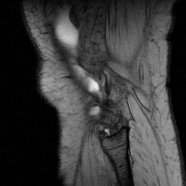 File:Bucket handle tear - medial meniscus (Radiopaedia 79028-91942 D 1).jpg