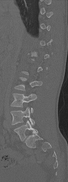 File:Burst fracture - T12 with conus compression (Radiopaedia 56825-63647 Sagittal bone window 56).png