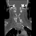 C1 anterior arch (plough) fracture - type 1 (Radiopaedia 76181-87720 Coronal bone window 45).jpg