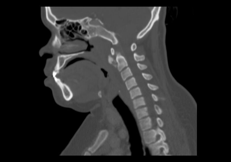 File:Calcific tendinitis of the longus colli muscle (Radiopaedia 28113-28371 Sagittal bone window 7).jpg