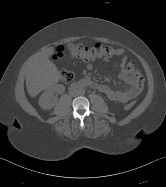File:Calcified hepatic hydatid cyst (Radiopaedia 81127-94738 Axial non-contrast 53).jpg