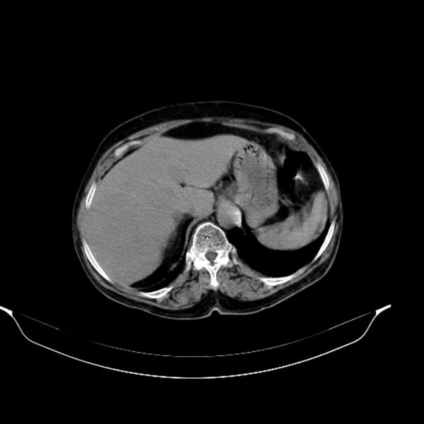 File:Calcified hydatid cyst (Radiopaedia 62000-70085 Axial non-contrast 29).jpg