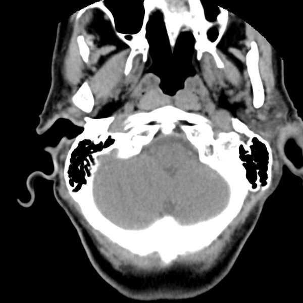 File:Calcified meningioma - cervical canal (Radiopaedia 70136-80171 B 1).jpg