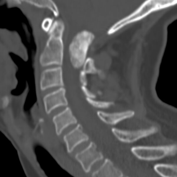 File:Calcified meningioma - cervical canal (Radiopaedia 70136-80171 Sagittal bone window 13).jpg