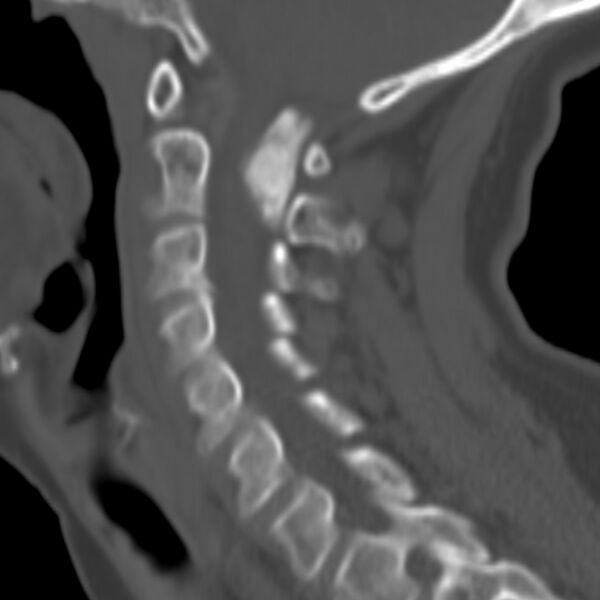 File:Calcified meningioma - cervical canal (Radiopaedia 70136-80171 Sagittal bone window 22).jpg
