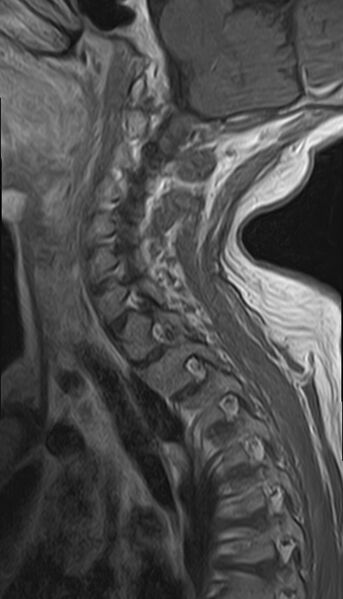 File:Calcified meningioma - cervical canal (Radiopaedia 70136-82468 Sagittal 5).jpg