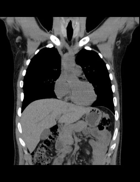 File:Calcifying pulmonary metastases (Radiopaedia 33359-34396 Coronal non-contrast 31).jpg