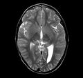 Callosal dysgenesis and ectopic posterior pituitary (Radiopaedia 8382-9213 Axial T2 8).jpg