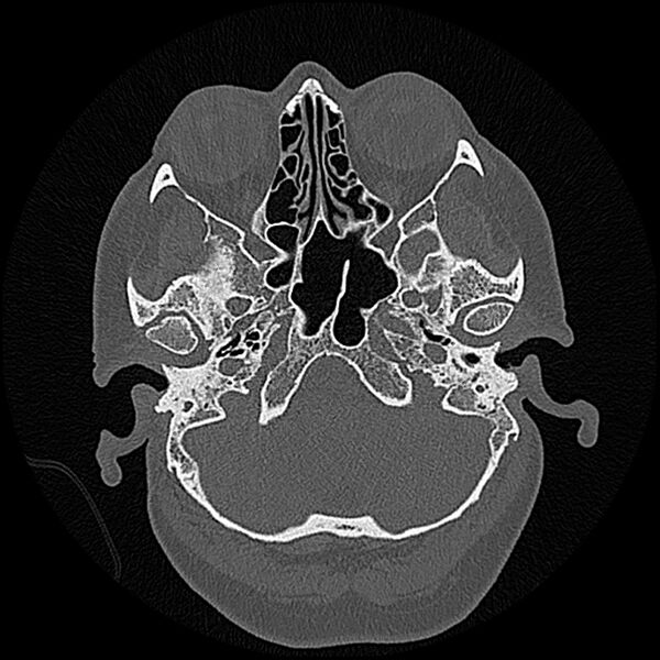 File:Canal up mastoidectomy (Radiopaedia 78108-90638 Axial bone window 43).jpg