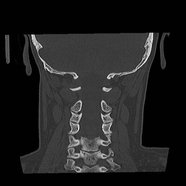 File:Canal up mastoidectomy (Radiopaedia 78108-90638 Coronal bone window 47).jpg