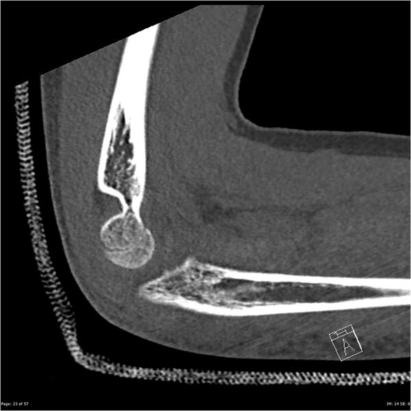File:Capitellum fracture (Radiopaedia 23352-23426 Sagittal bone window 23).jpg