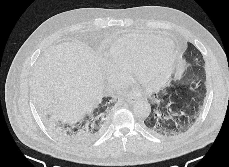 File:Cardiogenic pulmonary edema (Radiopaedia 68180-77678 Axial lung window 77).jpg