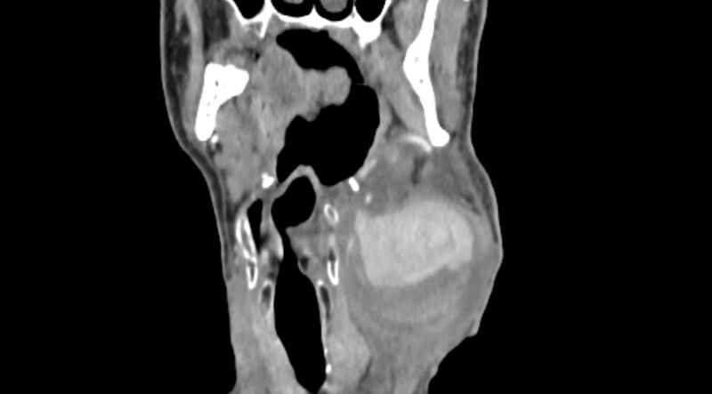 File:Carotid artery pseudoaneurysm (Radiopaedia 84030-99259 D 30).jpg