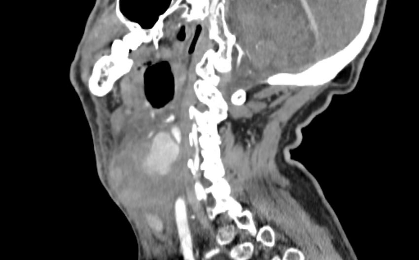 Carotid artery pseudoaneurysm (Radiopaedia 84030-99259 E 20).jpg