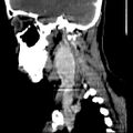 Carotid body tumor (Radiopaedia 27890-28124 C 17).jpg