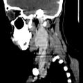 Carotid body tumor (Radiopaedia 27890-28124 C 18).jpg